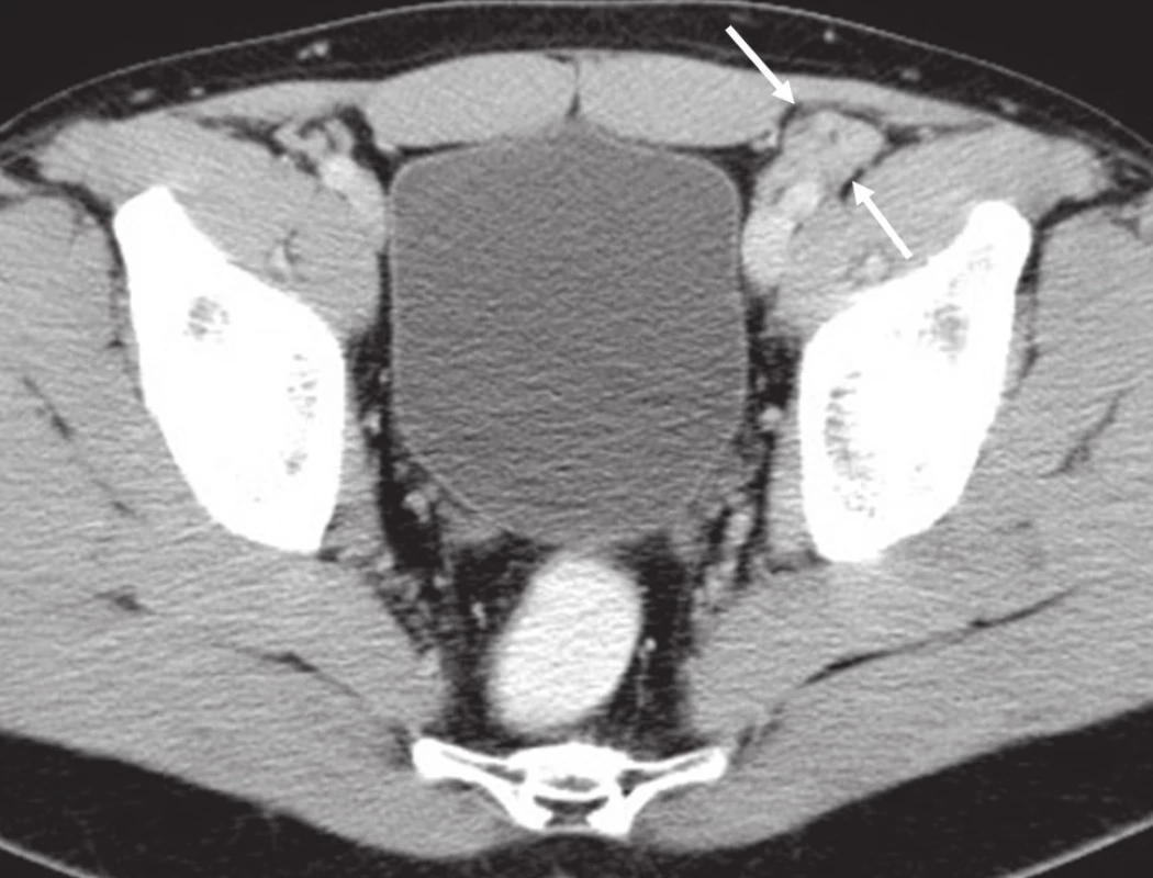 CT břicha, pánve, třísel: patologická lymfatická uzlina zevní ilická vlevo.