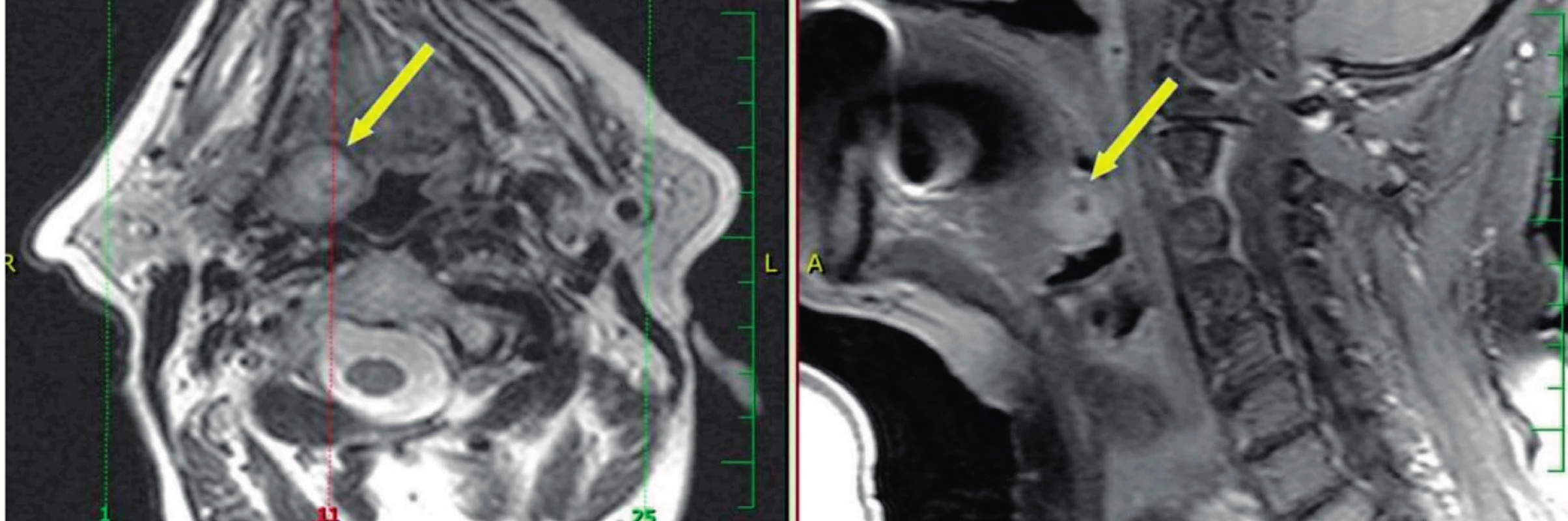 Vlevo MR T2 vážený obraz, vpravo MR T1 s potlačením signálu tuku postkontrastně - šipka ukazuje na povrchově uložený karcinom kořene jazyka stadia T1, velmi dobře přístupný pro TORS.