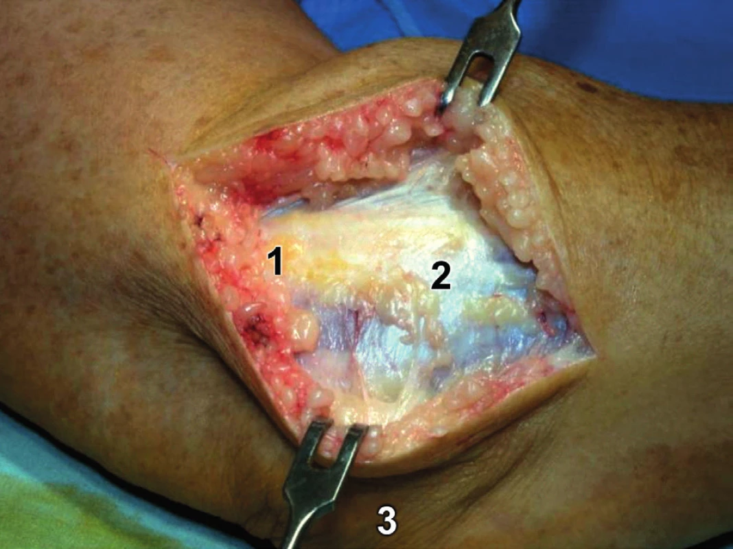Modifikovaný Kocherův přístup – kožní řez: 1 – epicondylus lateralis humeri, 2 – fascie extenzorů, 3 – olekranon.
Fig. 7: Modified Kocher approach – skin incision: 1 – lateral epicondyle of humerus, 2 – common extensor fascia, 3 – olecranon.