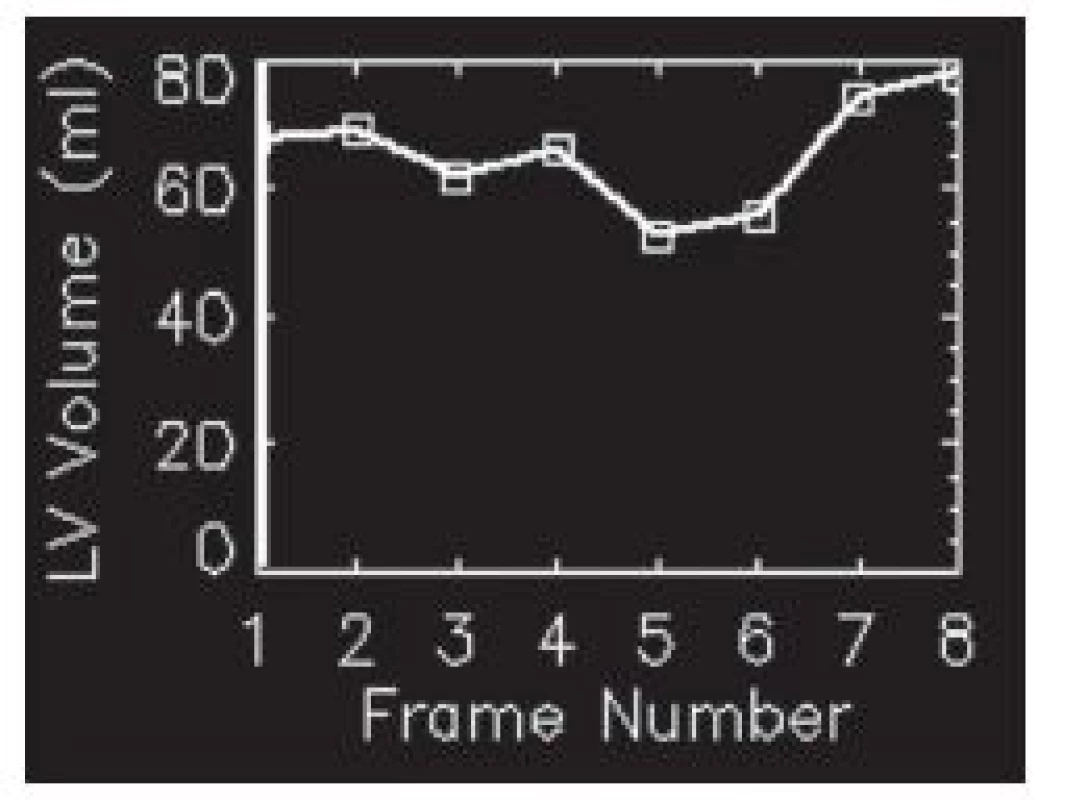 Objemová křivka s dvěma vrcholy – synchronizace u této studie neproběhla správně.