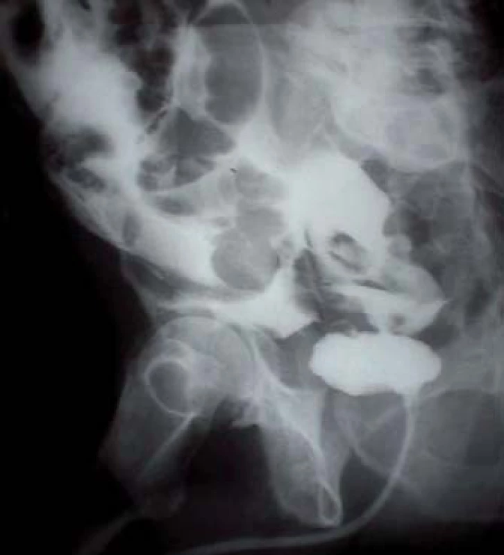 Cystografie zobrazující intraperitoneální rupturu močového měchýře.