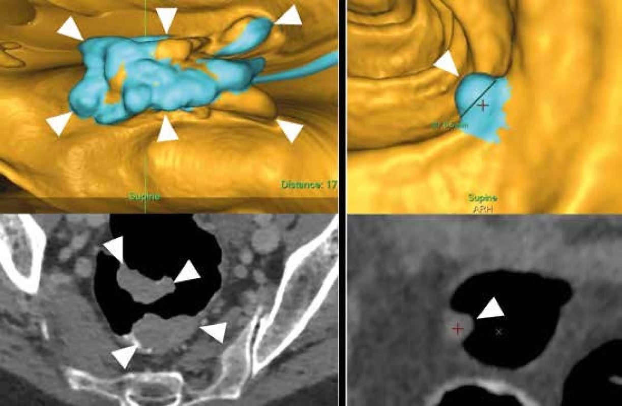 Nádorová formace na přechodu rekta a sigmatu u 69leté pacientky v „rozloženém“ endoluminálním obraze („fillet view“, vlevo nahoře) a na axiálním řezu (C-RADS C4, vlevo dole). Přisedlý polyp sigmatu velikosti 6,5 mm ve virtuálně endoskopickém obraze (vpravo nahoře) a na tenkých řezech (C-RADS C2, vpravo dole) u 62leté pacientky