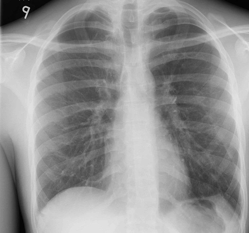 Skiagram plic při dimisi – plíce plně rozvinuty V obou plicních vrcholech jsou patrné řetízky svorek po endostaplerové resekci patologicky změněných apexů plic.
