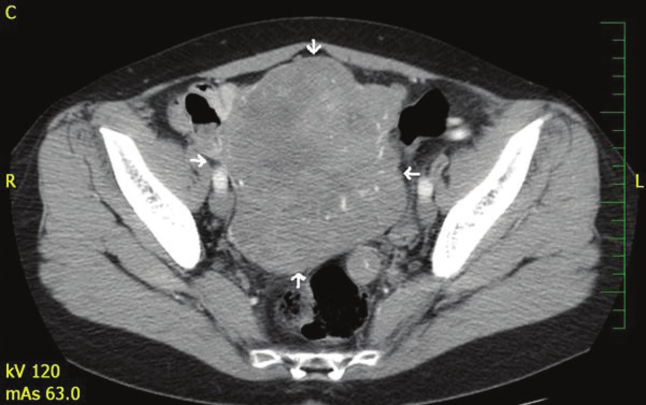 CT břicha s nálezem expanze v dutině břišní a malé pánvi
Fig. 2: CT of the abdomen with a finding of expansion in the abdominal cavity and small pelvis