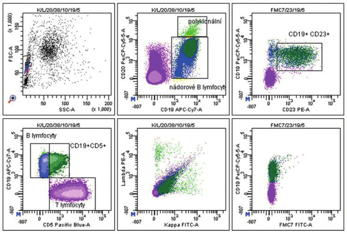 Pacient 3. Ve vyšetřovaném vzorku kostní dřeně byly zastiženy T-lymfocyty (znázorněny fialově), polyklonální zralé B-lymfocyty (znázorněny světle zelenou barvou) a dále patologická populace B-lymfocytů (6,5 % z celku) s imunofenotypem CD20(slabě)+ CD19+ CD23+ CD5+/- kappa (suspekně velmi slabě)+ CD10- CD38- FMC7- (zobrazeny modrou a tmavě zelenou barvou, v závislosti na expresi molekuly CD5). Nález svědčí pro infiltraci kostní dřeně již dříve histologicky diagnostikovanou B-CLL CD38-.