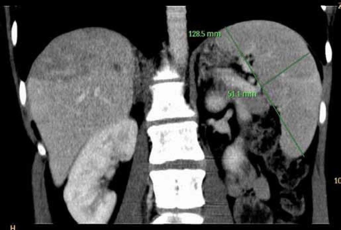 Trojfázové CT jater: venózní fáze – splenomegalie.
Fig. 2. Contrast CT of liver: venous phase – splenomegaly.
