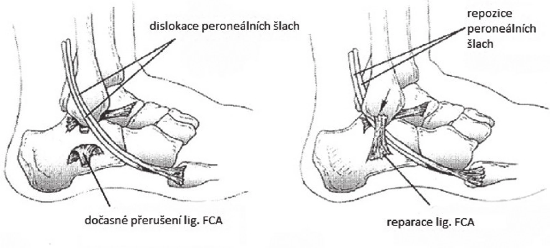 Přemístění peroneálních šlach za kalkaneofibulární ligamentum, metoda dle Platzgummera