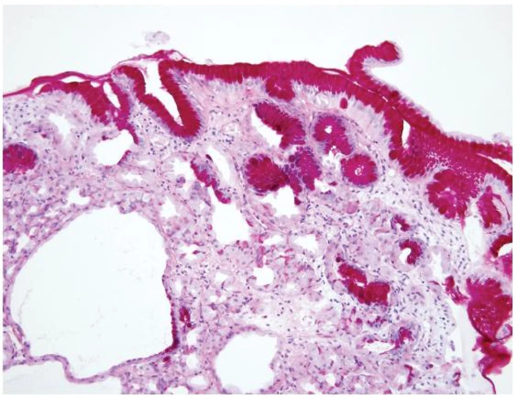 Cystický polyp žlázek žaludečního těla
Výstelka cyst je místy oploštělá s podílem parietálních buněk, hlavních buněk a mucinózních epitelií (PAS-alciánová modř, 200×).