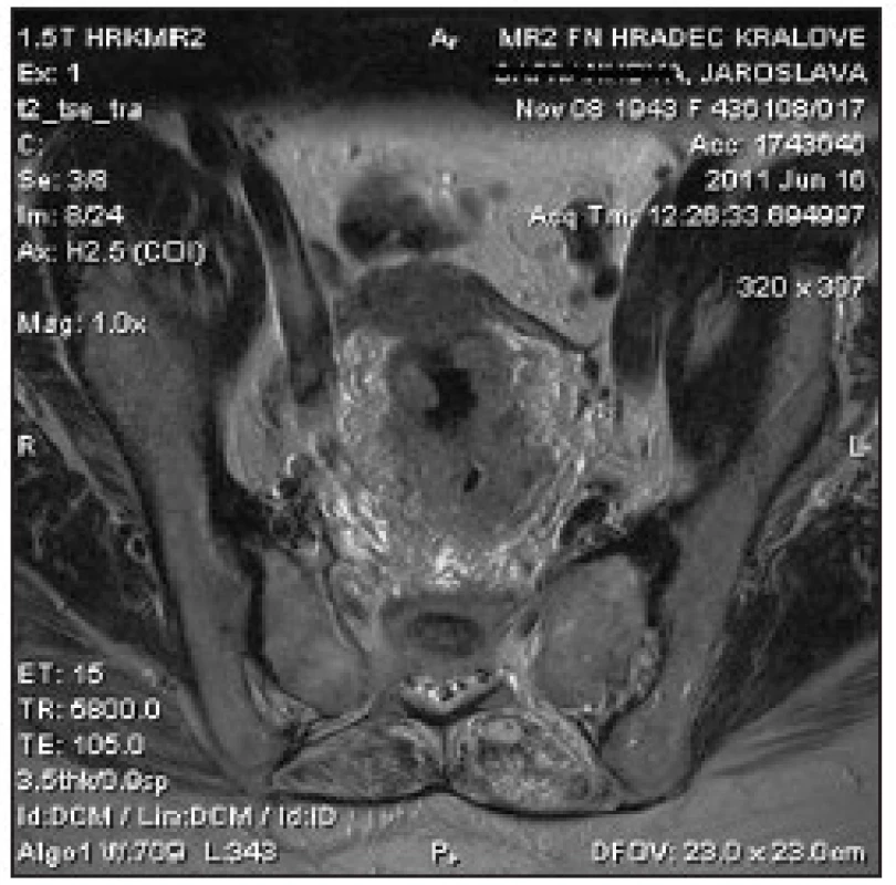 Vyšetření MRI, transverzální řez, T2 zobrazení. Karcinom středního rekta, pokročilý T3 nádor s těsným vztahem k mezorektální fascii na č. 4–6.