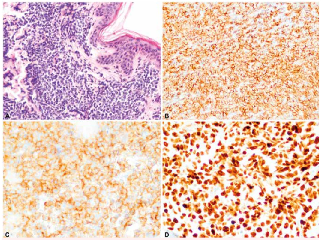 Imunohistochemické barvení kožní biopsie na markery specifické pro BPDCN