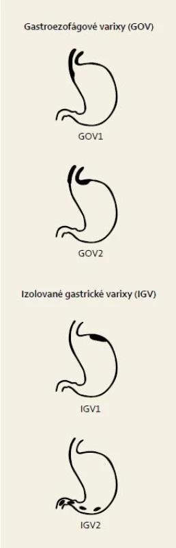 Klasifikácia gastroezofágových varixov [15]. 
Fig. 4. Classification of gastroesophageal varices [15].