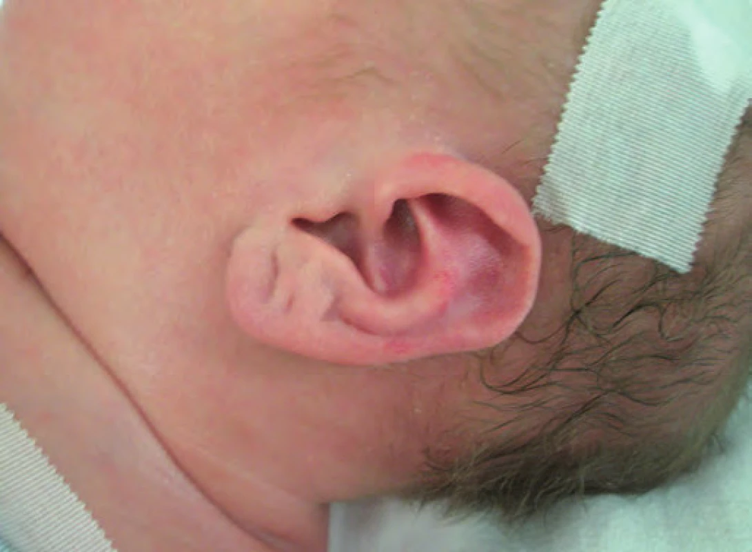 Beckwith-Wiedemannův syndrom (BWS), atypické rýhy a dolíčky na ušních lalůčcích.