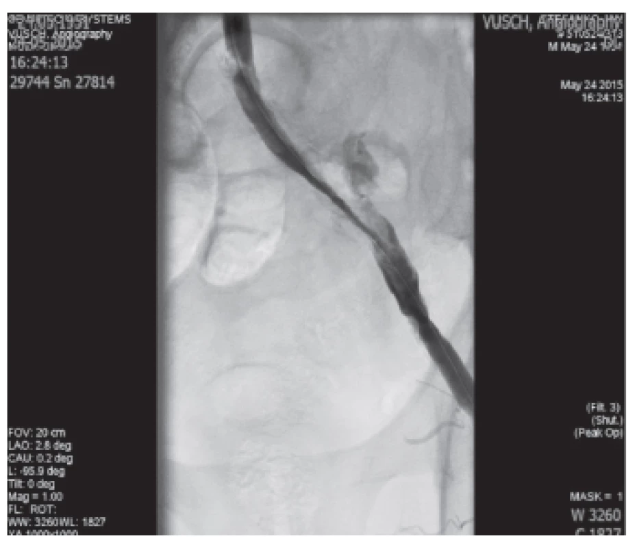 Implantácia stentgraftu do AIE l.sin.
Fig. 5: Implantation of the stentgraft in AIE l.sin.