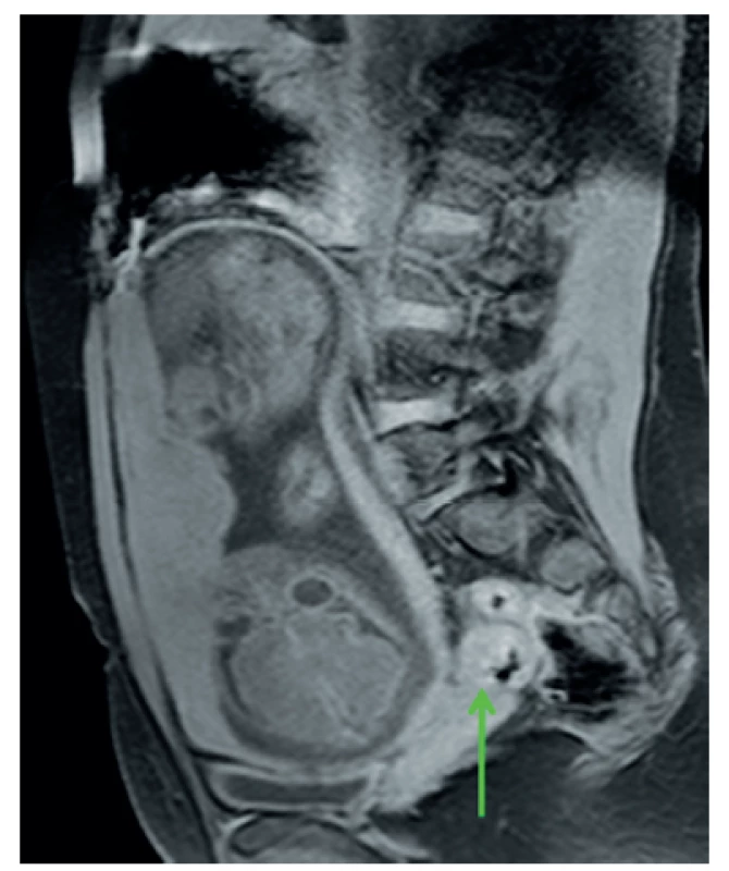 Sagittal MRI of the abdomen/pelvis showing a single intrauterine foetus and sigmoid colon tumour (arrow)
