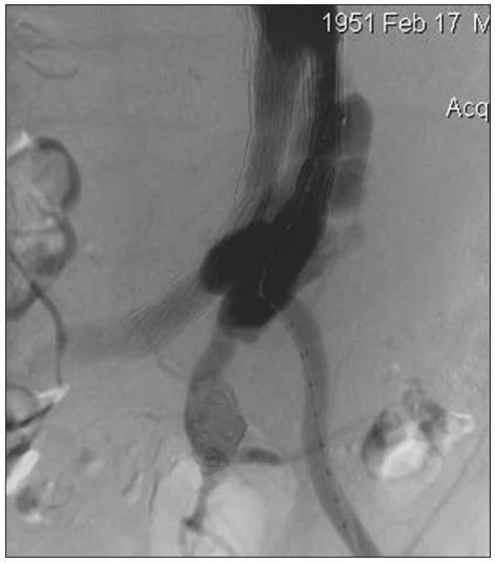 Angiografie před ošetřením Ib endoleaku (zobrazena i embolizovaná výduť levé vnitřní ilické tepny)
Fig. 2. An angiography before management of type Ib endoleak (with embolised aneurysm of left internal iliac artery)