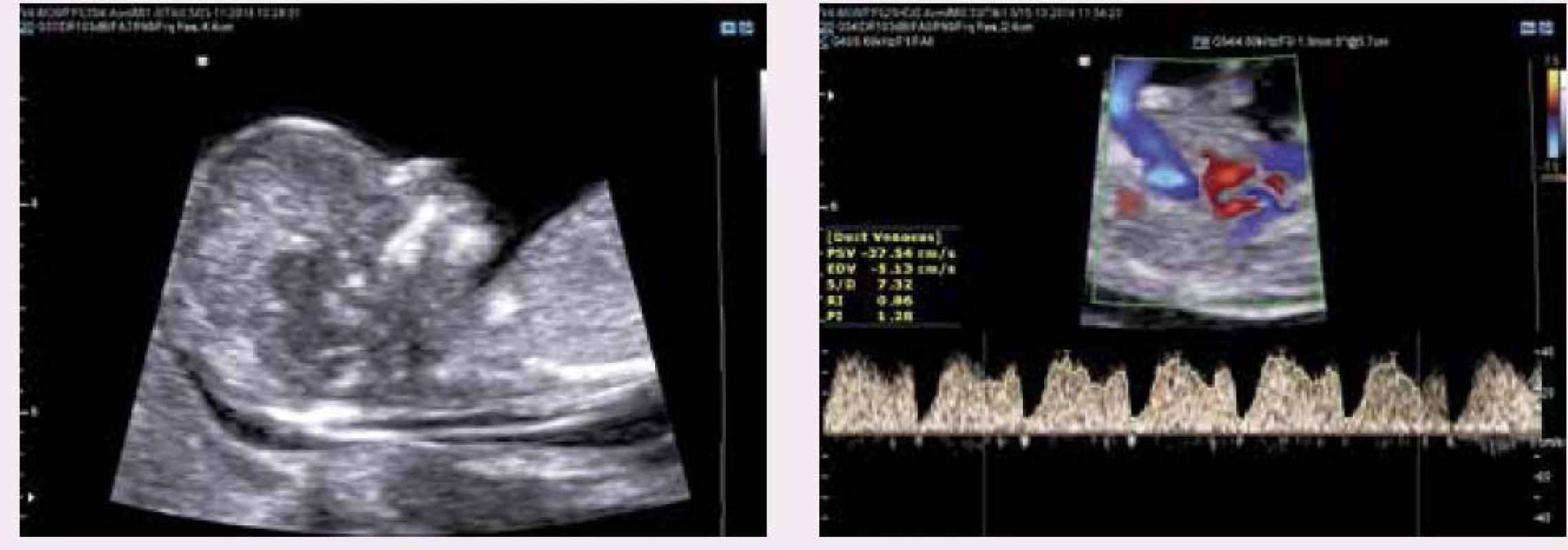 Ultrazvukové vyšetření novějších prvotrimestrálních markerů Downova syndromu dle FMF protokolu (normální nálezy): (a) nosní kůstky (b) dopplerovské vyšetření trojcípé chlopně (c) dopplerovské vyšetření PI v ductus venosus