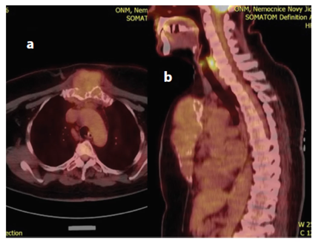 a,b: a) PET/CT obraz prokazující vyšší akumulaci 2-deoxy-2-[18F]fluoro-D-glukózy (18F-FDG) s hodnotami SUV 3,59 v oblasti sterna; b) Metastáza renálního karcinomu sterna v sagitálním PET/CT zobrazení. 
Fig. 2 a,b: a) PET/CT scan showing accumulation of 18F-FDG in the sternum with SUV 3.59; b) Sagittal plane PET/CT scan showing sternal metastasis from renal carcinoma.