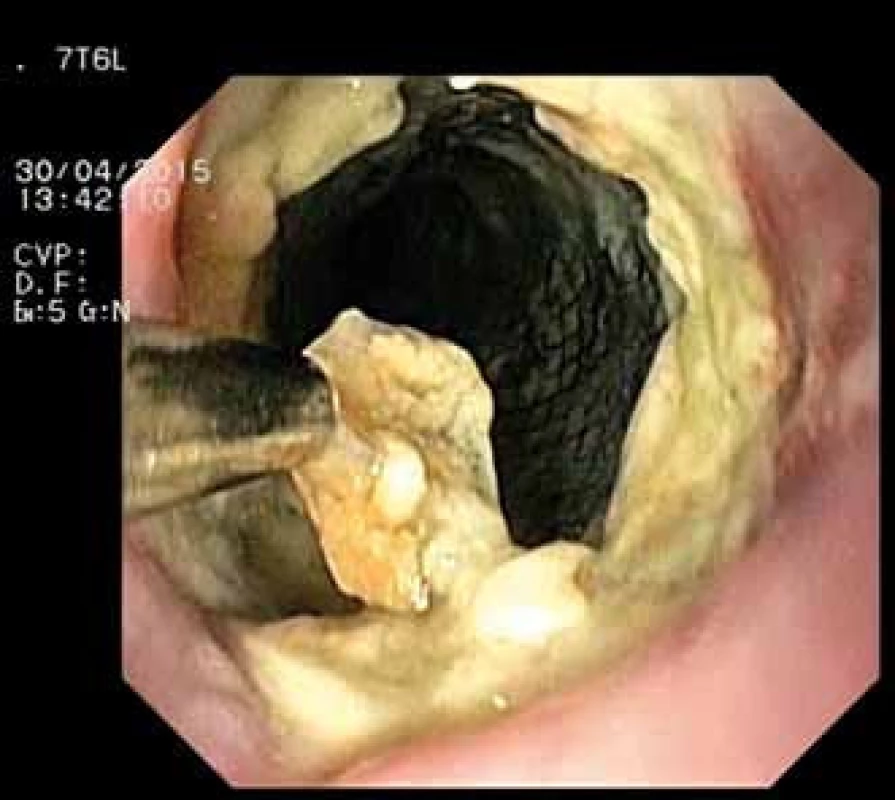 Extrakce Danišova stentu – endoskopický obraz).
Fig. 2. Extraction of Danis stent – endoscopic image.