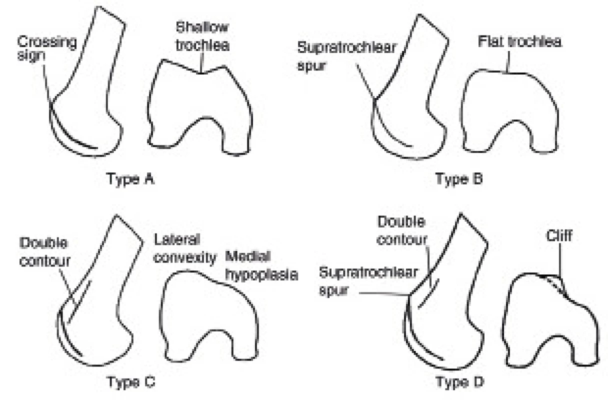 Klasifikace dysplazie trochley podle Dejoura.
&lt;i&gt;(Převzato z Dejour D, LeCoultre B. Osteotomies in patello-femoral instabilities. Sports Med Arthrosc 2007; 15: 39–46.)&lt;/i&gt;
Fig. 2. Dejour classification of trochlear dysplasia.
&lt;i&gt;(From Dejour D, LeCoultre B. Osteotomies in patello-femoral instabilities. Sports Med Arthrosc 2007; 15: 39–46.)&lt;/i&gt;