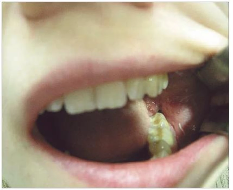 Poextrakční zánět zubního lůžka po extrakci zubu 38, třetí den po chirurgické extrakci