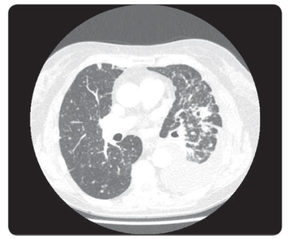 Kazuistika 1, CT hrudníku 9/2018 (před zahájení léčby).
©FNOL 2018.<br>
CT – výpočetní tomografie
