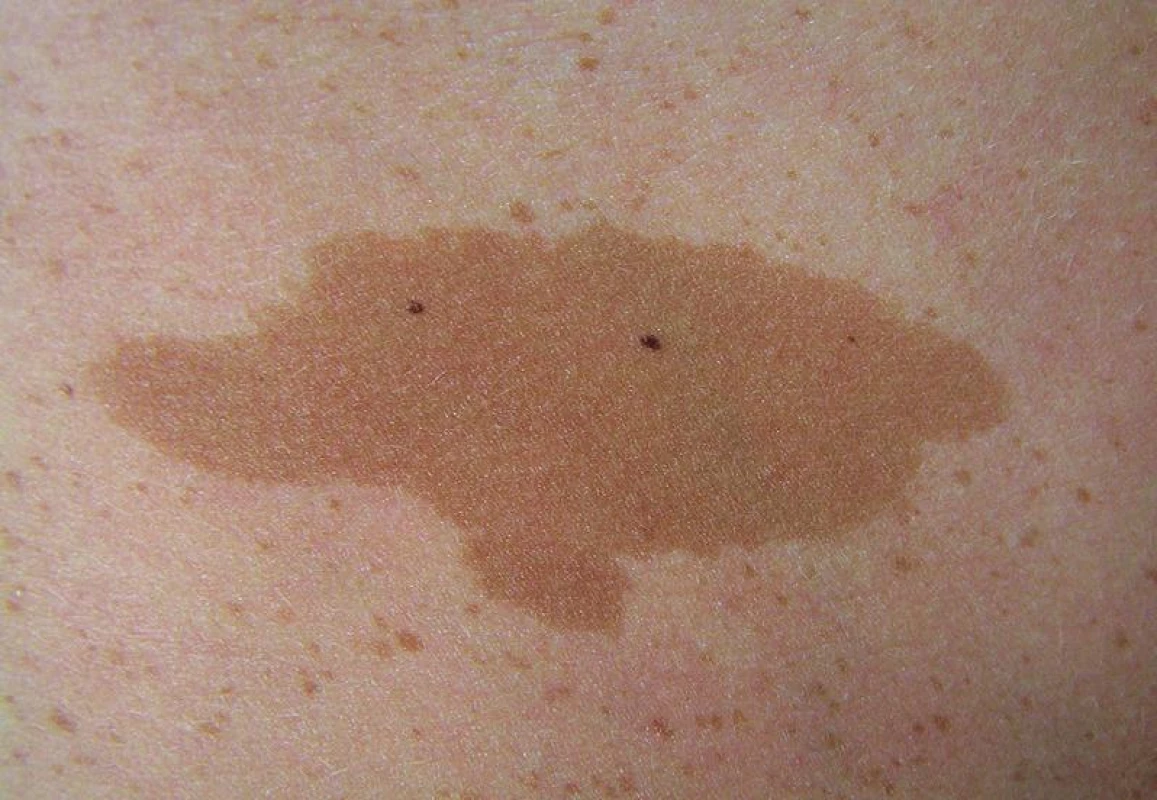 Skvrna café-au-lait na kůži trupu, v okolí patrny mnohočetné drobné skvrnité pigmentace (freckling)