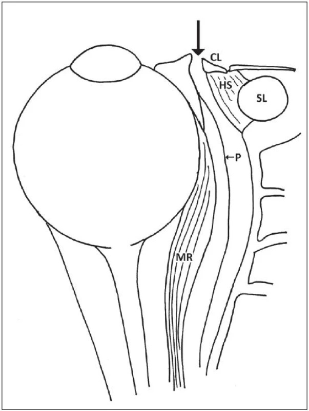 Disekce mezi caruncula lacrimalis a plica semilunaris a dále mezi periorbitou a mediální stěnou orbity.
