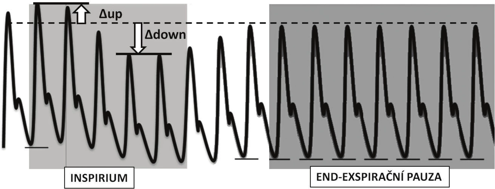 Znázornění změn křivky arteriálního tlaku při ventilaci pozitivním přetlakem a po vřazení krátké endexspirační pauzy