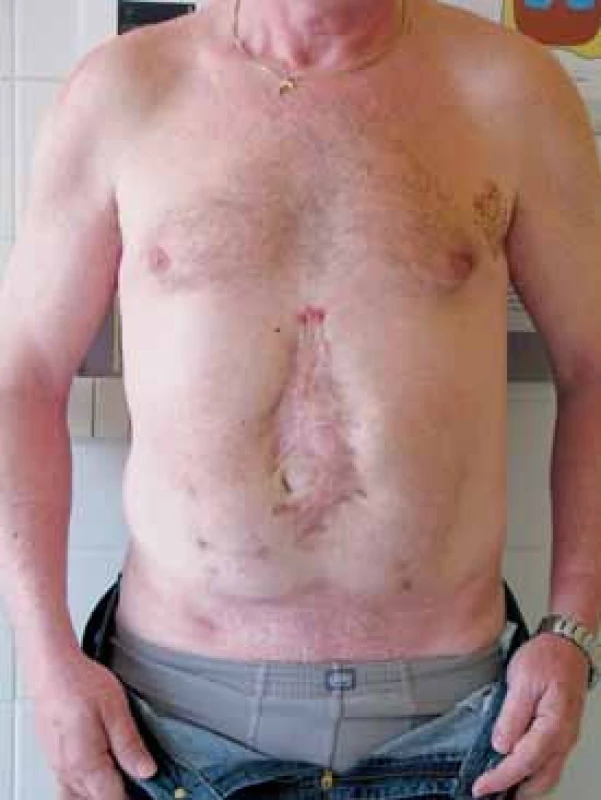 Pacient po břišní operaci pro akutní pankreatitidu
Fig 3. Patient after abdominal surgery dute to acute pancreatitis