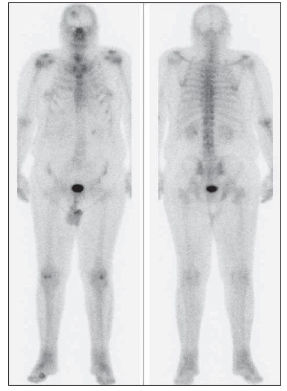 Celotělová scintigrafie skeletu z přední a zadní projekce, zvýšená osteoblastická aktivita v kalvě frontálně vpravo.