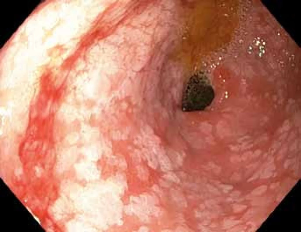 Gastroskopie v bílém světle – pohled do antra žaludku s bělavými mapovitými plochami intestinální metaplazie, v levé dolní části obrázku je patrné lehce zarudlé ložisko dysplazie vysokého stupně.