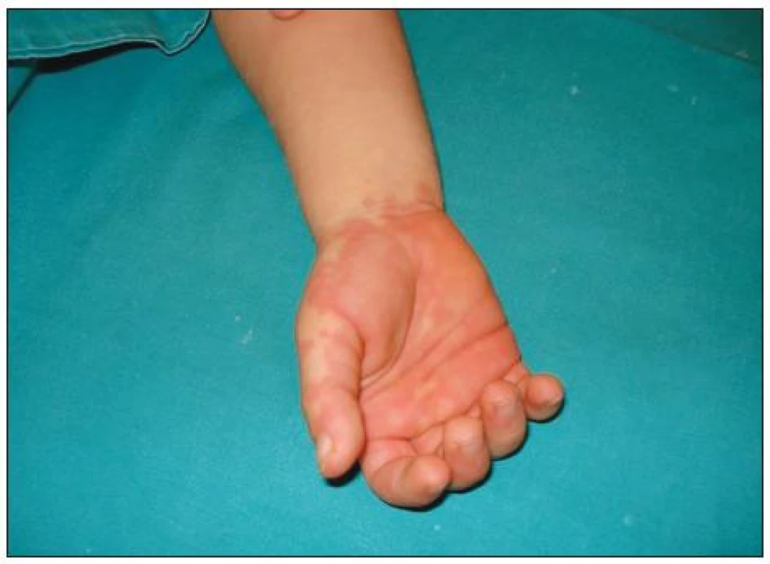 Zarudnutí dlaní u nemocného s Kawasakiho syndromem.
&lt;em&gt;(Archiv dr. F. Falcini, Itálie, publikování s povolením autora i rodiny.)&lt;/em&gt;
