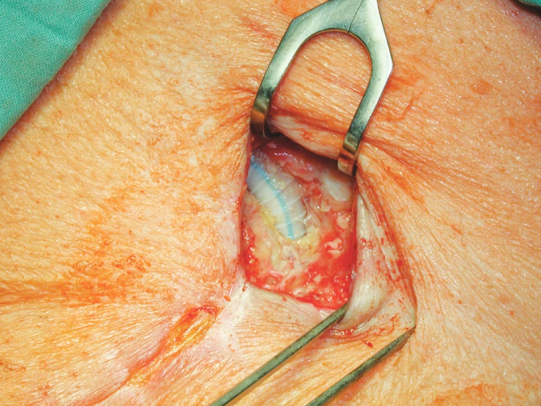 Stav po nekrektomii před přiložením V.A.C.
Fig. 3. A wound after necrectomy before V.A.C. application
