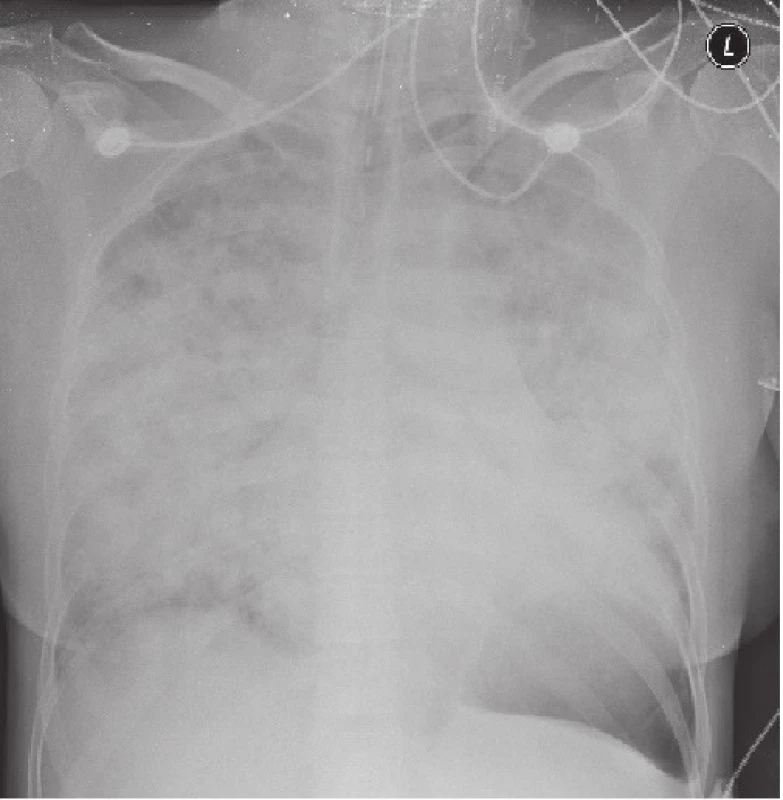 RTG snímek plic s infiltráty v obou plicních křídlech.