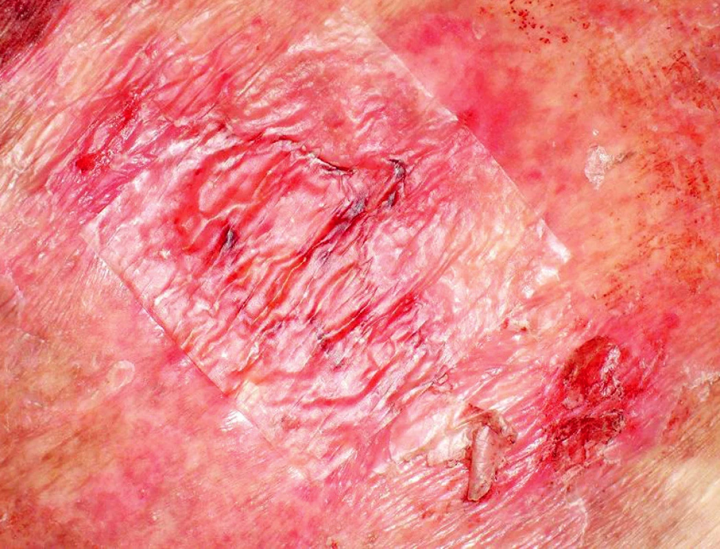 Kožní defekt krytý Xe Dermou (biologický kožní kryt)