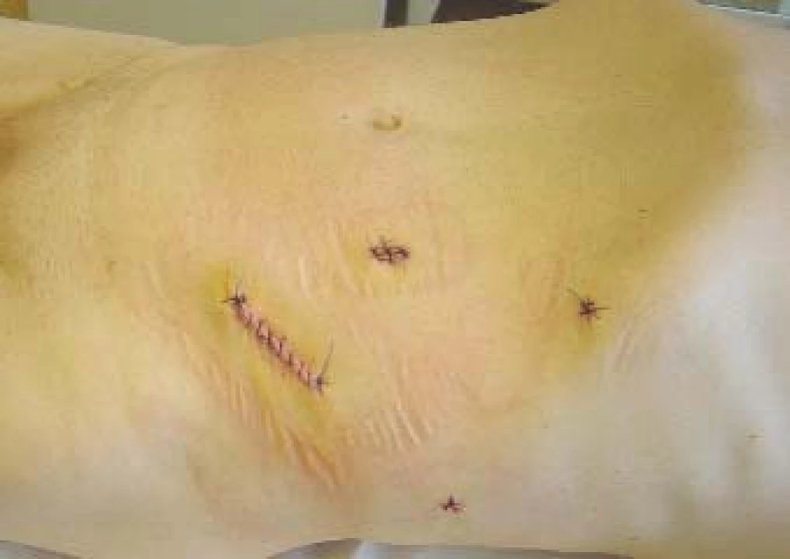 Fotografie břicha pacienta po radikální laparoskopické nefrektomii vlevo.