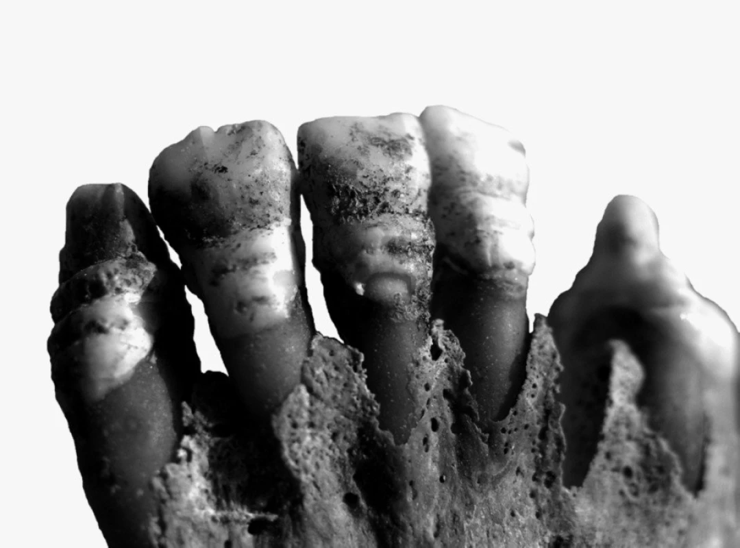 Fragmenty lebky gracilní 14–18leté dívky (hrob č. A 1843) s výraznou hypoplázií zubů.