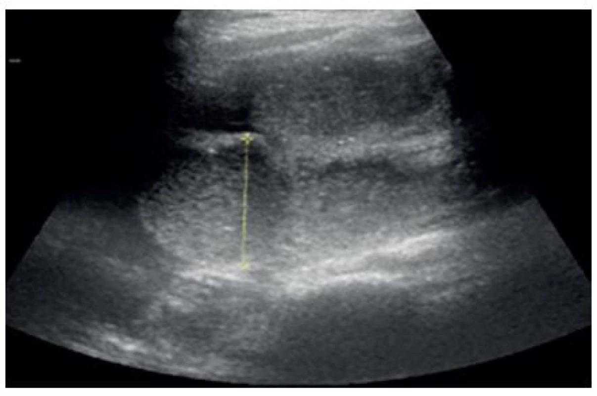Dilatované kličky ilea
Fig. 1: Distension of the small intestine