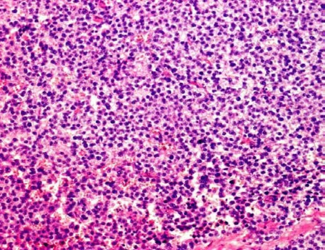Mikroskopický preparát – klasický seminom, barvení HE, zvětšení 200x
Fig. 6. Histopathological image of seminoma, HE stain, at 200x