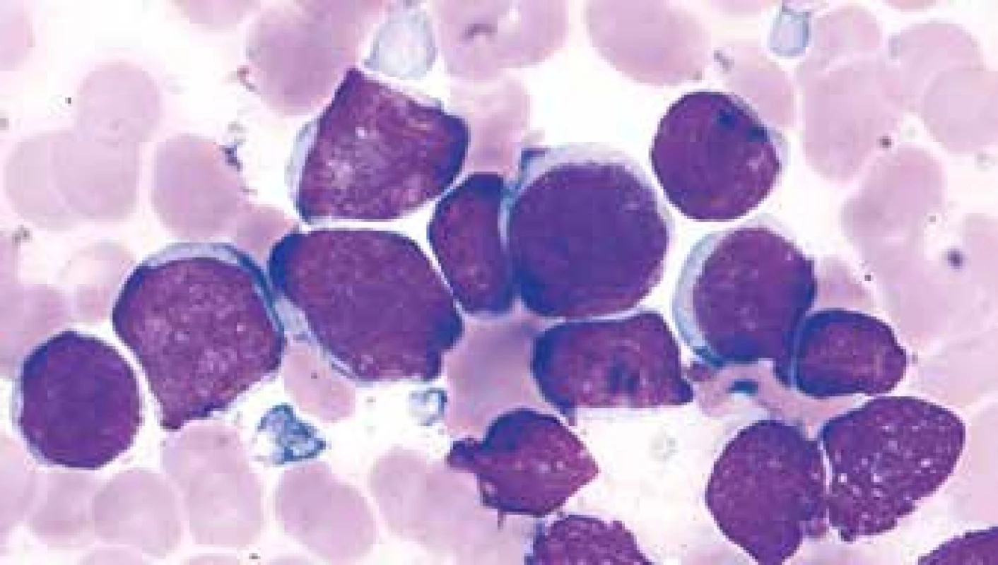 MCL, blastoidní varianta (velké anizomorfní lymfocyty s nepravidelnou bazofilní cytoplazmou, vysokým nukleocytoplazmatickým poměrem, méně kondenzovaným jaderným chromatinem a nenápadnými nukleoly)
