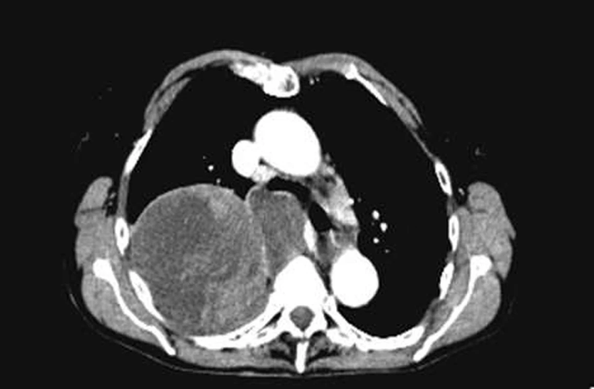 CT – špatně diferencovaný sarkom v horním laloku pravé plíce.