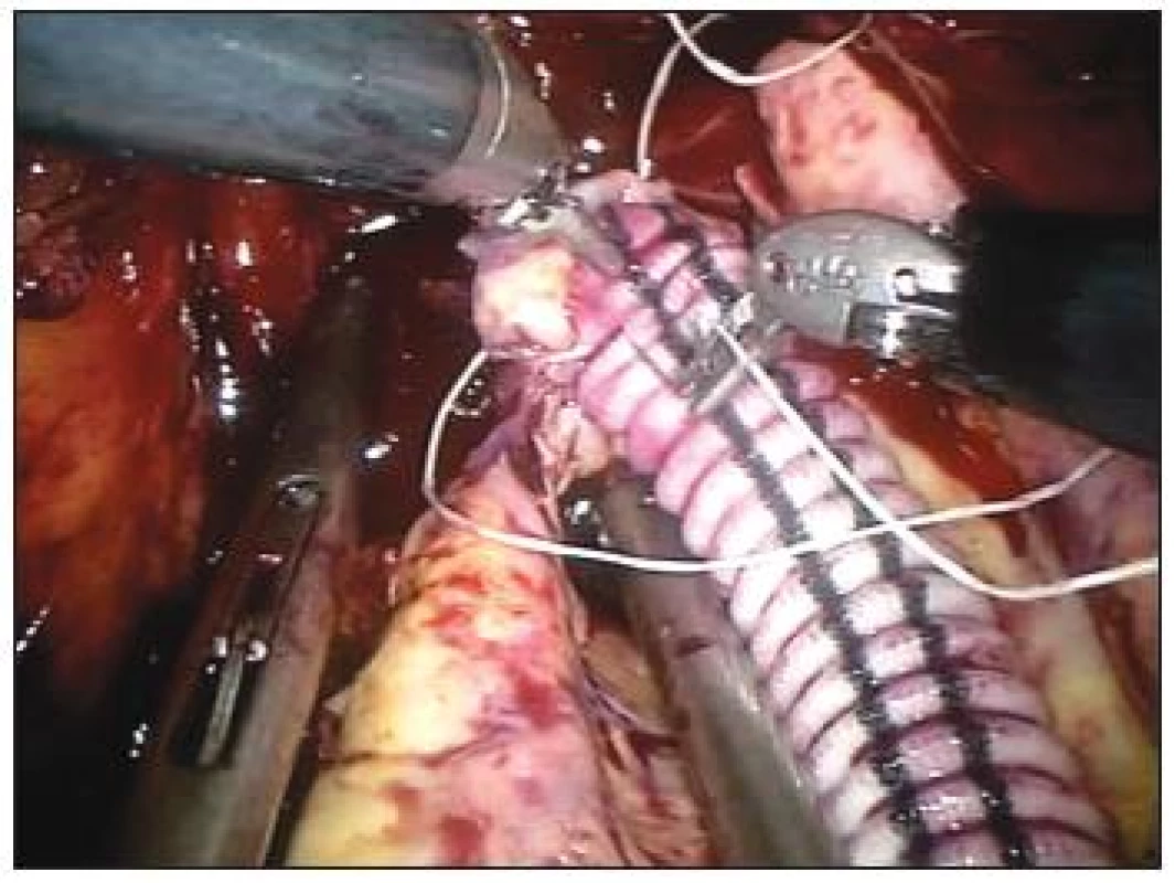 Výduť pánevní tepny, periferní anastomóza
Fig. 3. Aneurysm of the pelvic aorta, peripheral anastomosis