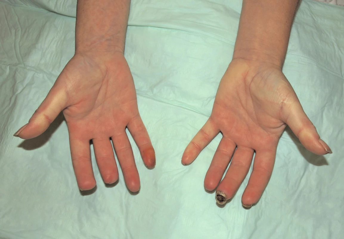 Stav v prosinci 2010.
Suchá gangréna distální falangy 3. prstu levé ruky, stav po amputaci distálního článku 2. a 3. prstu pravé ruky.