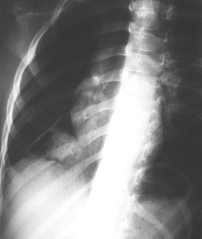 RTG snímka hrudníka, kde suponované na Tu expanziu vpravo bazálne
Fig. 5. Chest x-ray, a supposed tumor expansion in the right base.