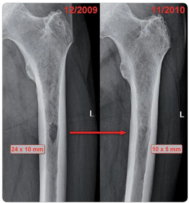 Zřetelné známky hojení osteolytického procesu v levé kosti stehenní po podání režimu s bortezomibem (Velcade™).