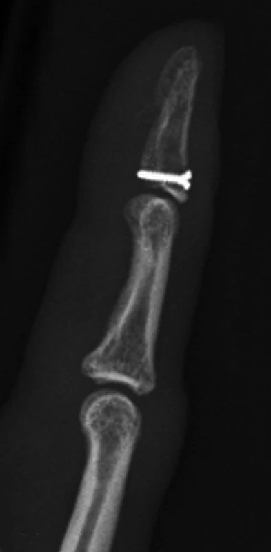 Osteosyntéza šroubem velikosti 1,3 mm.
