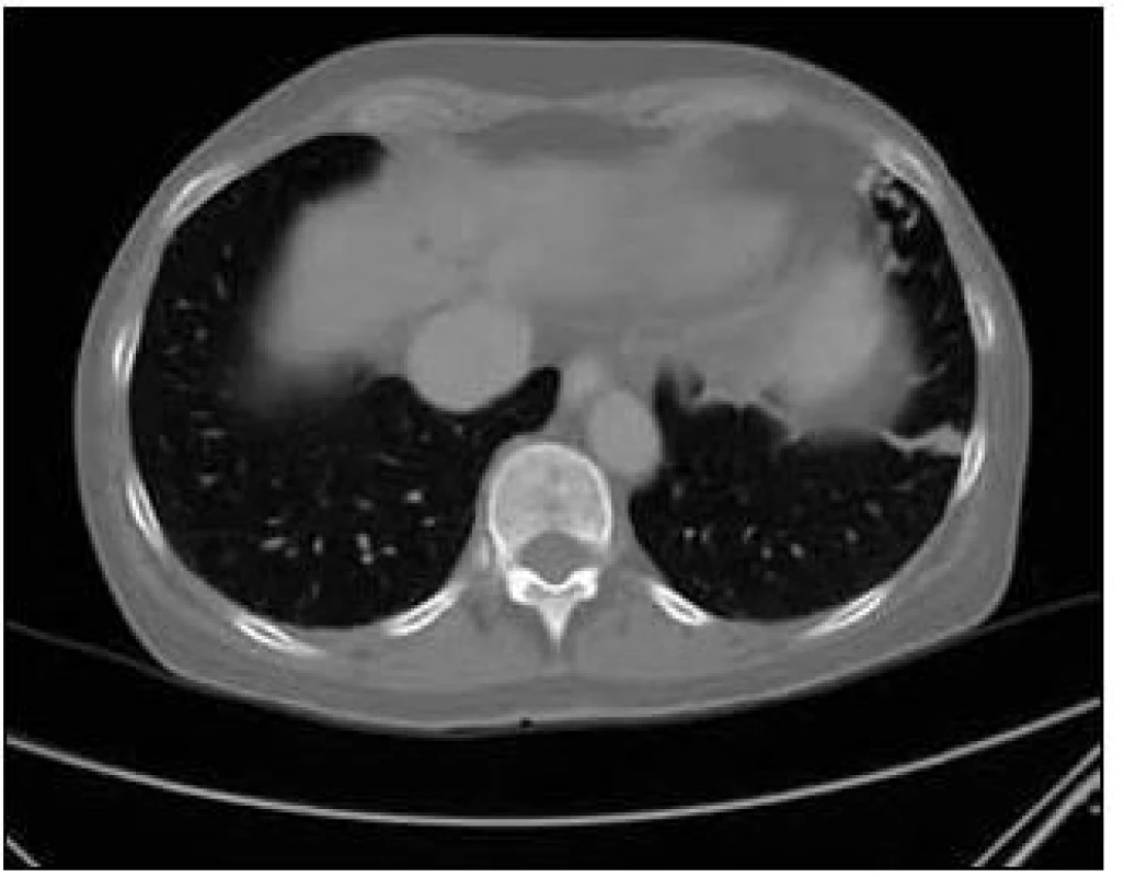 CT zobrazení plíce: Arteriovenózní malformace v lingule levé plíce a rarefakce obratlového těla.
