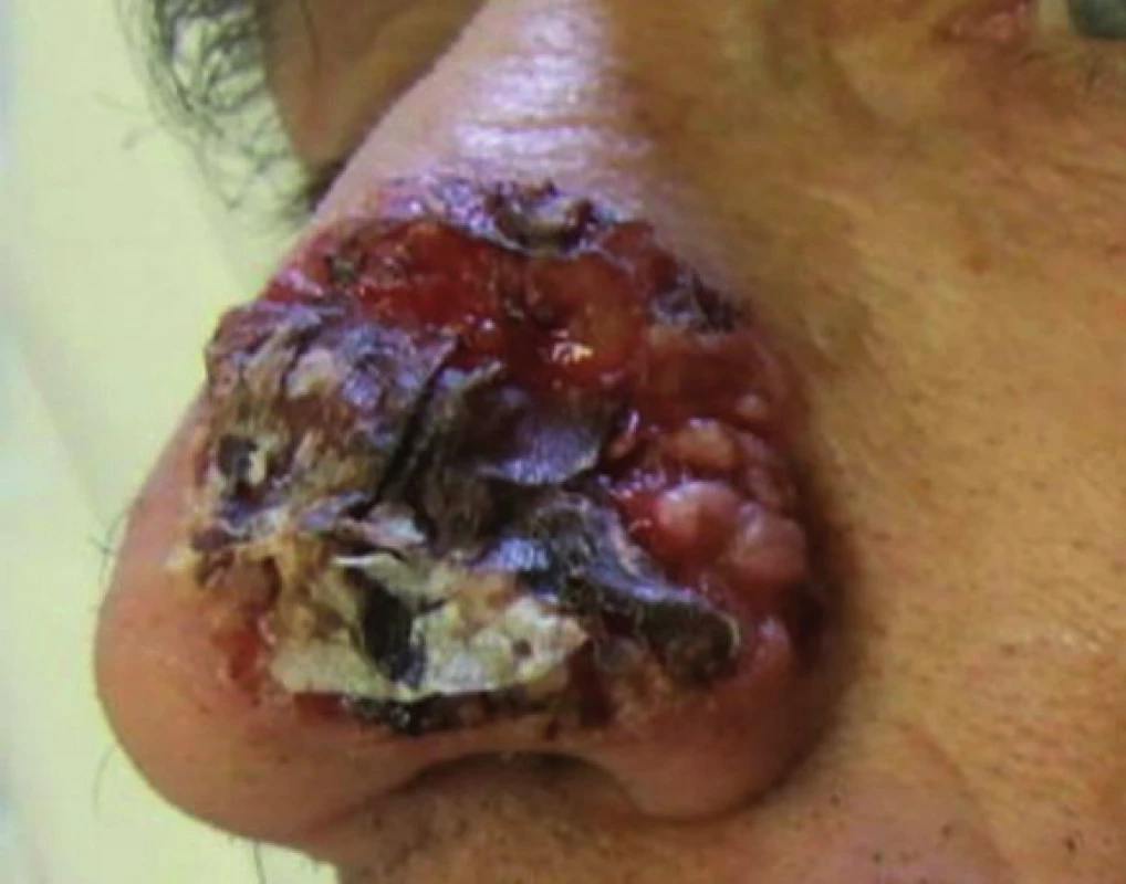 Rozsiahly agresívne rastúci bazocelulárny karcinóm nosa s výraznou ulceráciou a deštrukciou okolitého tkaniva (fotografia poskytnutá láskavosťou MUDr. Milady Kullovej, primárky Oddelenia dermatovenerológie FNsP v Žiline).