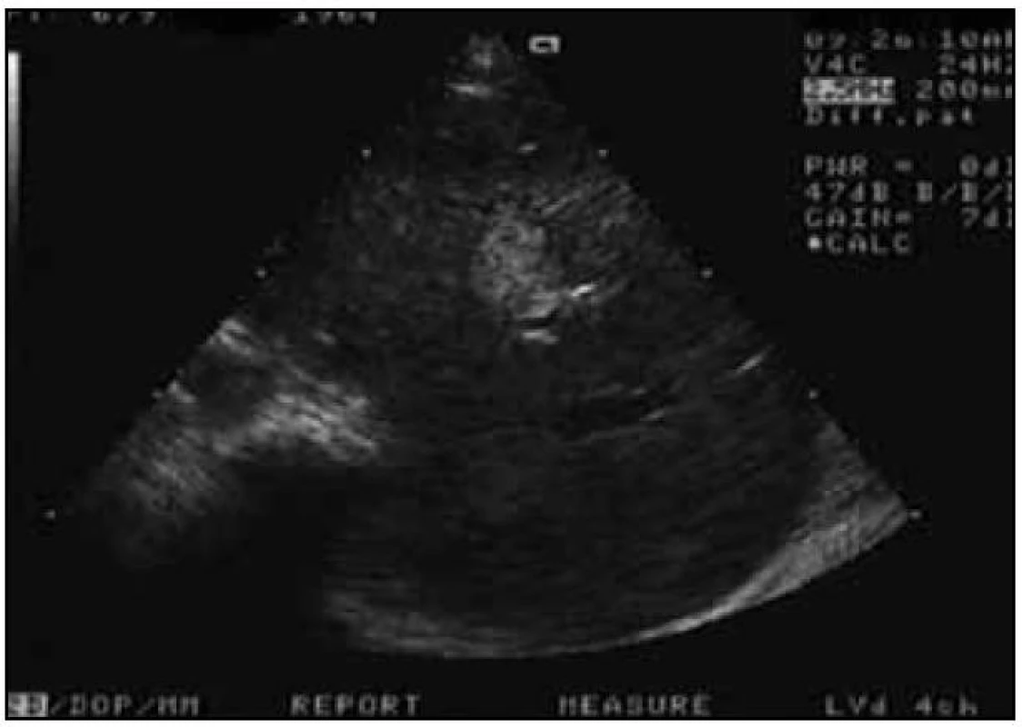 Ultrazvuk břicha (UZV) verifikuje ložiskové postižení jater.