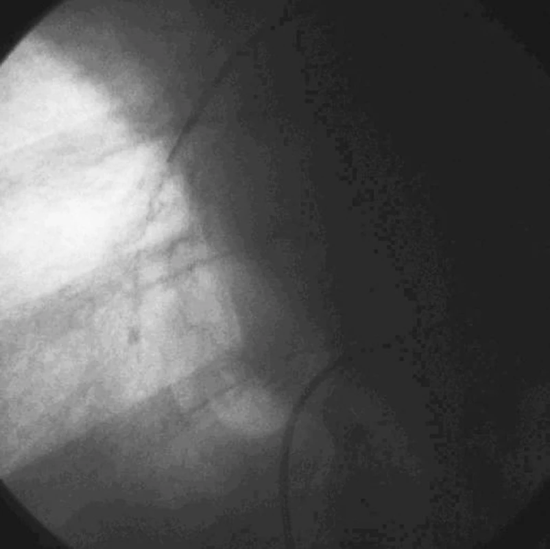 Zavedení katétru do pravé plicní artérie
Fig. 1. Catheter introduction into the right pulmonary artery